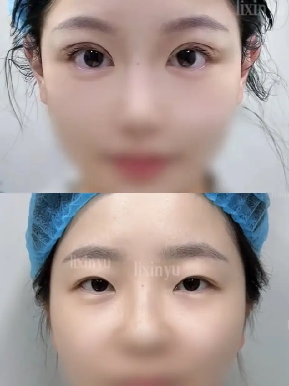 Double Eyelid